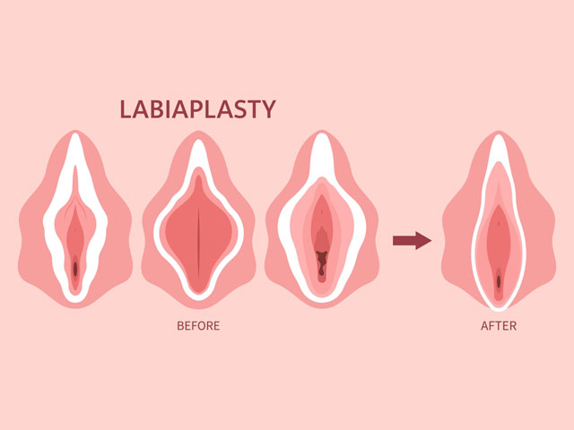 Labiaplasty.jpg