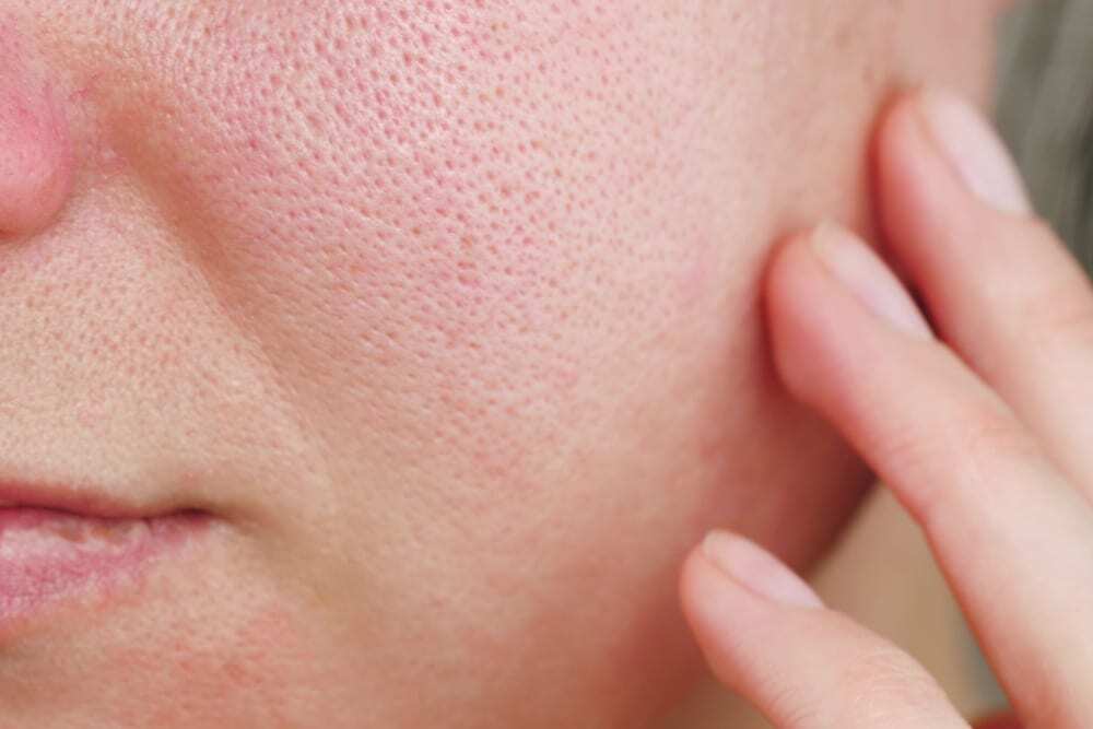 Open-Pores.jpeg
