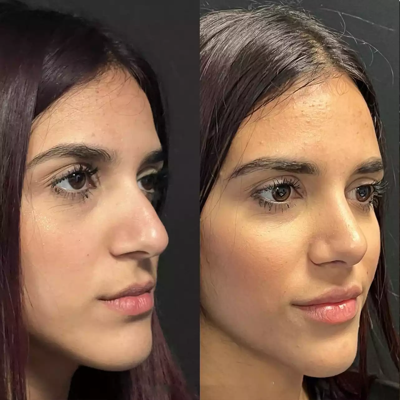 Rhinoplasty2.webp